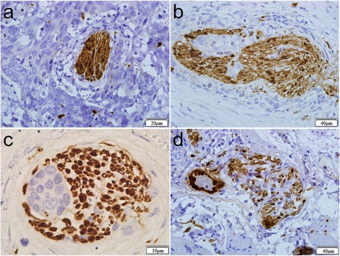 Figure 4: Variety patterns of the histologic appearance of PNI in ESCC.
