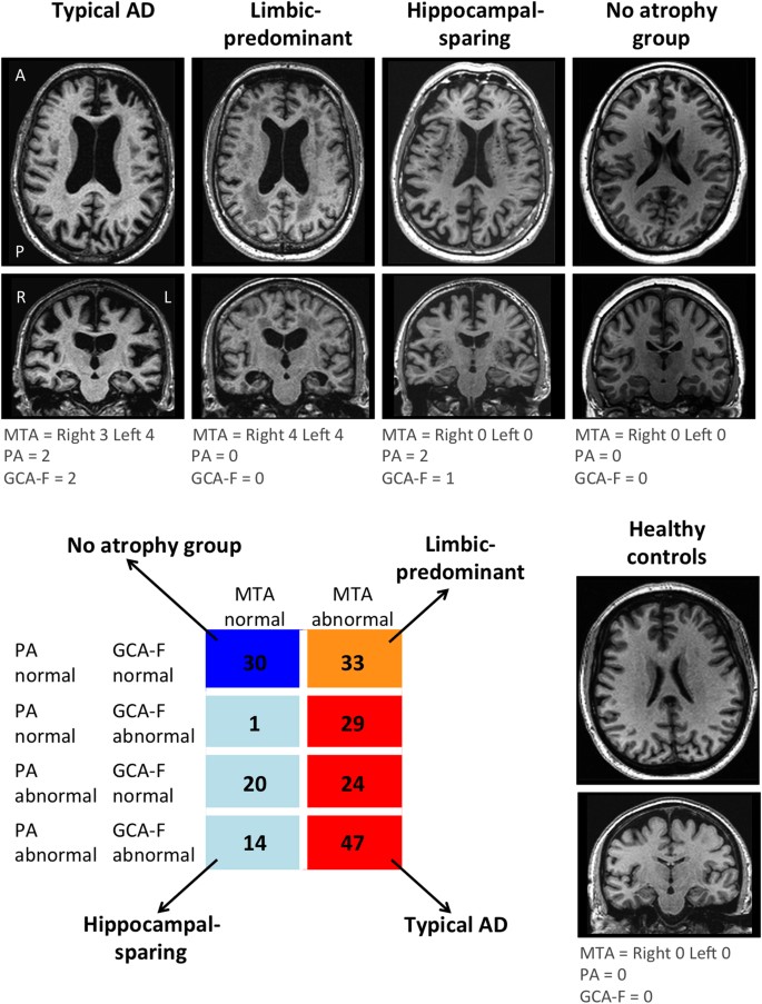 Distinct subtypes of Alzheimer's disease based on patterns of brain  atrophy: longitudinal trajectories and clinical applications | Scientific  Reports