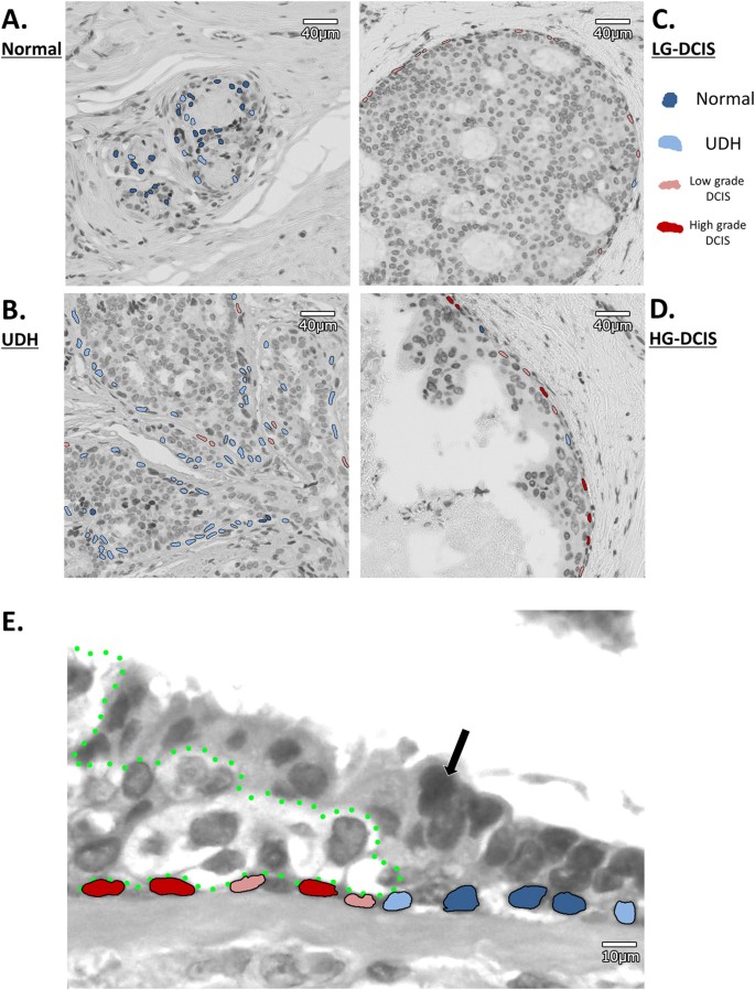 Breast cancer evaluation by fluorescent dot detection using combined  mathematical morphology and multifractal techniques, Diagnostic Pathology