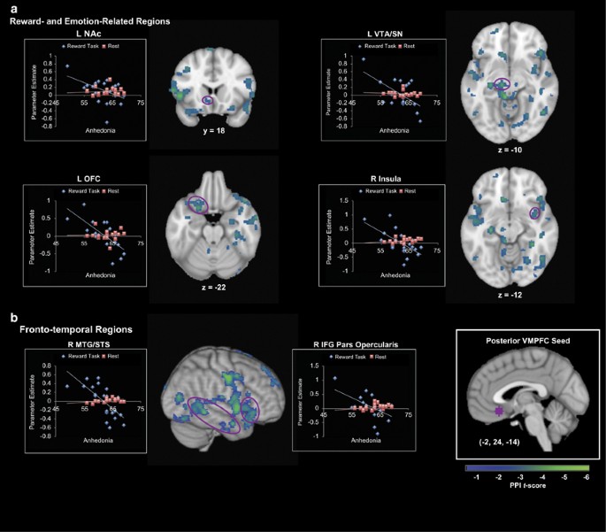 pt141 anhedonia and general distress show dissociable ventromedial prefrontal cortex connectivity in major depressive disorder Anhedonia, Life Without Pleasure