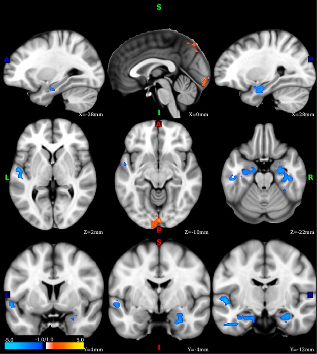 Anterior hippocampal in stress disorder: a and multimodal approach | Translational Psychiatry