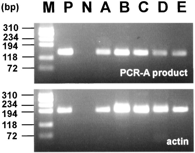 Involvement Of The Chromosomal Translocation T 11 18 In Some Mucosa Associated Lymphoid Tissue Lymphomas And Diffuse Large B Cell Lymphomas Of The Ocular Adnexaevidence From Multiplex Reverse Transcriptase Polymerase Chain Reaction And Fluorescence In