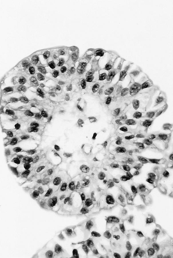 urothelial papilloma with atypia medicamente antiparazitare cu spectru larg de prevenire
