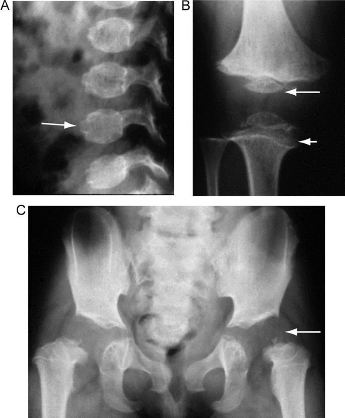 Facial dysmorphism, skeletal anomalies, congenital glucoma