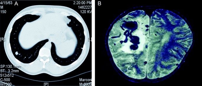 Hereditary Hemorrhagic Telangiectasia An Overview Of Diagnosis Management And Pathogenesis Genetics In Medicine Hereditary Hemorrhagic Telangiectasia An Overview Of Diagnosis Management And Pathogenesis Genetics In Medicine