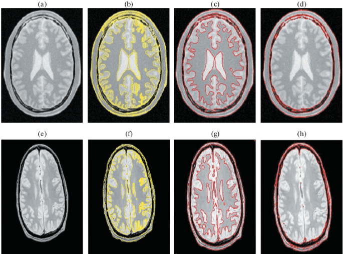 A Hybrid Segmentation Approach of Brain Magnetic Resonance Imaging 