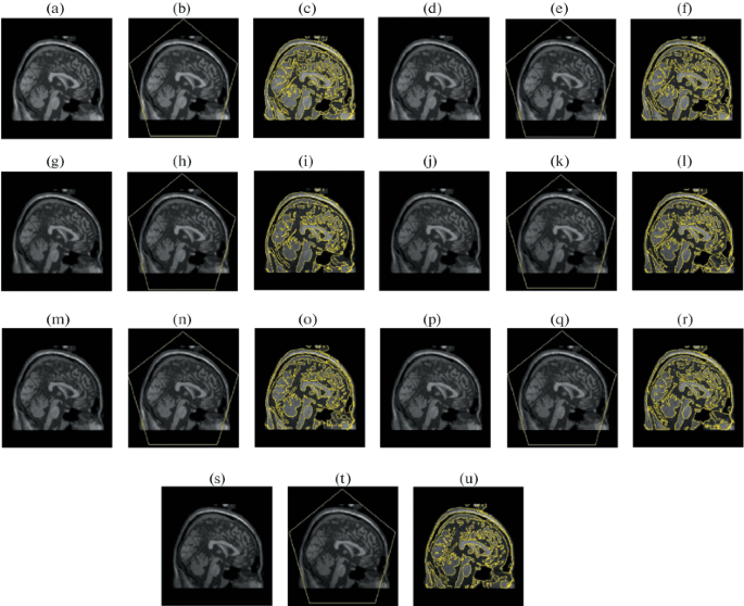 A Hybrid Segmentation Approach of Brain Magnetic Resonance Imaging 