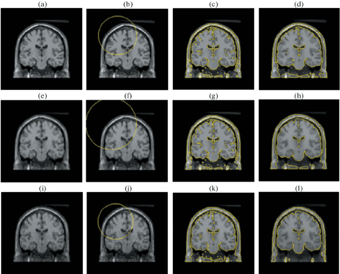 A Hybrid Segmentation Approach of Brain Magnetic Resonance Imaging 