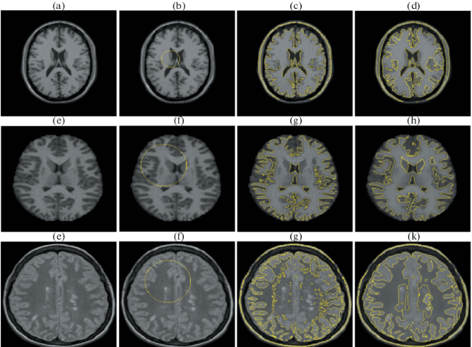 A Hybrid Segmentation Approach of Brain Magnetic Resonance Imaging 