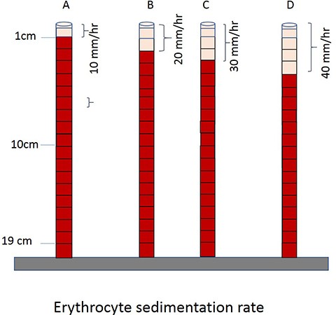 Sedimentation rate of erythrocyte from physics prospective | SpringerLink