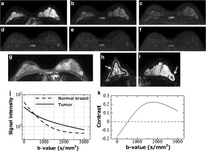 Investigation of the optimal b-value to detect breast tumors with diffusion  weighted imaging by 1.5-T MRI | Cancer Imaging | Full Text
