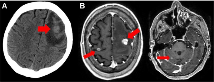 The role of magnetic resonance imaging in the management of brain  metastases: diagnosis to prognosis | Cancer Imaging | Full Text