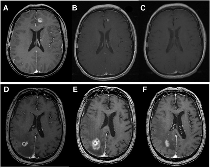 The role of magnetic resonance imaging in the management of brain  metastases: diagnosis to prognosis | Cancer Imaging | Full Text