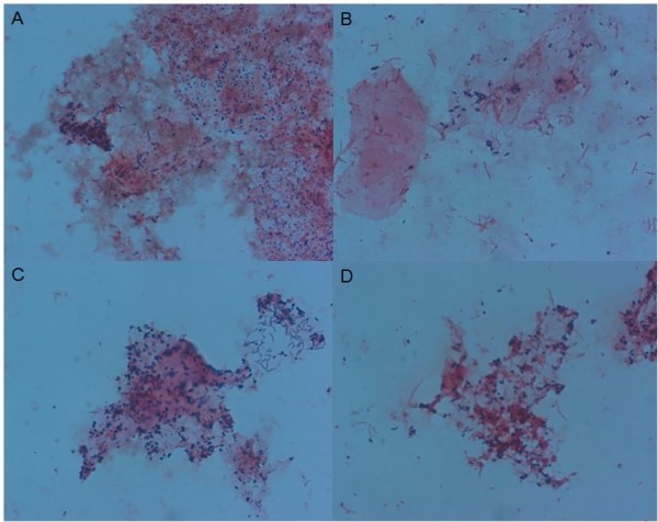 Mobiluncus spp corynebacterium в мазке. Палочки дедерлейна микроскопия. палочки дедерлейна под микроскопом. палочки дедерлейна в мазке. палочки дедерлейна в цервикальном канале.