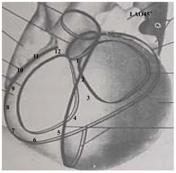 Idiopathic Premature Ventricular Contractions And Ventricular Tachycardias Originating From The Vicinity Of Tricuspid Annulus Results Of Radiofrequency Catheter Ablation In Thirty Five Patients Bmc Cardiovascular Disorders Full Text