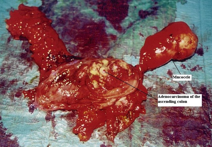 Cystadenocarcinoma of the appendix: an incidental imaging finding in a  patient with adenocarcinomas of the ascending and the sigmoid colon | BMC  Gastroenterology | Full Text