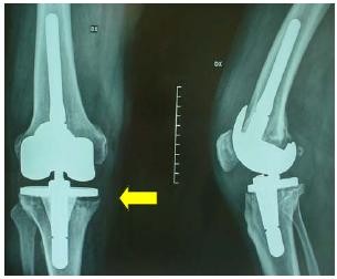 Osteomyelitis