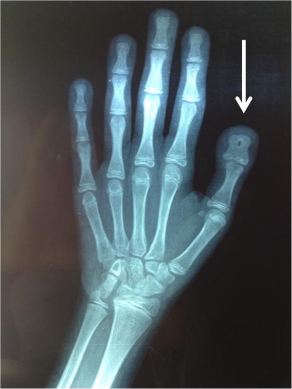 Pediatric on Squares on X: Rubinstein Taybi Syndrome #Pediatric