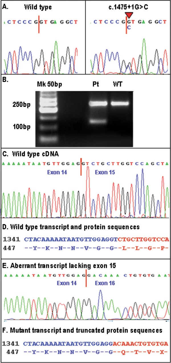 Branchio Oto Renal Syndrome Bor Associated With Focal Glomerulosclerosis In A Patient With A Novel Eya1 Splice Site Mutation Bmc Nephrology Full Text