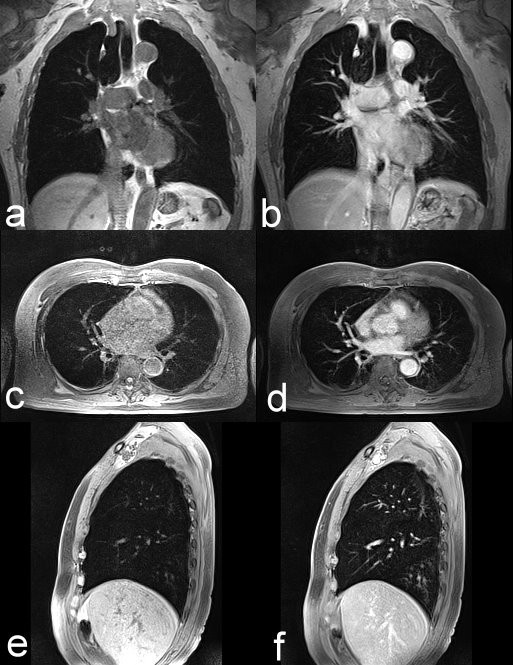 Magnetic imaging for lung cancer detection: Experience in a population of more than 10,000 individuals | BMC Cancer | Text