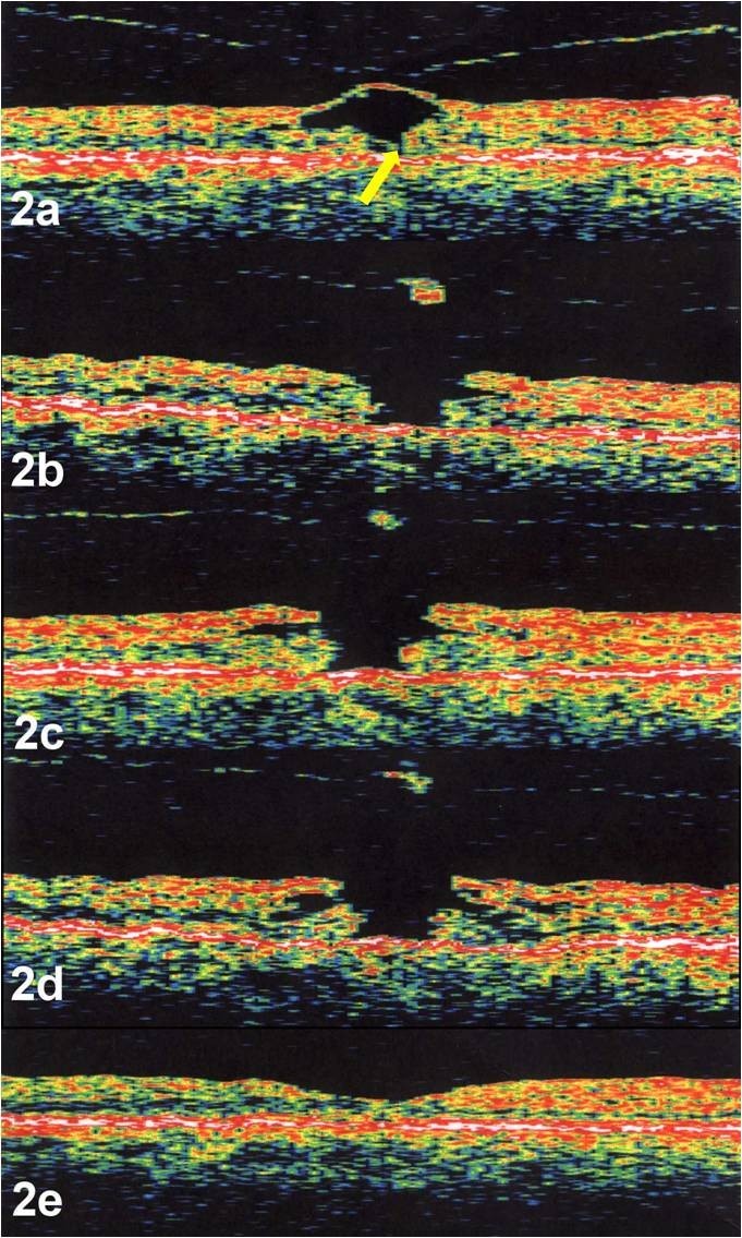 Macular hole formation, progression, and surgical repair: case series of  serial optical coherence tomography and time lapse morphing video study |  BMC Ophthalmology | Full Text