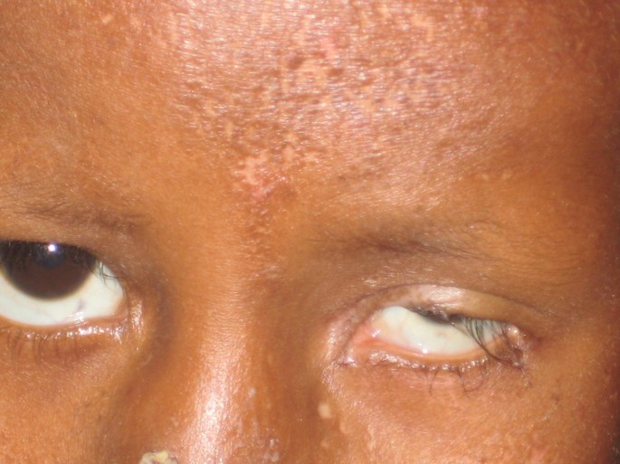 Goltz syndrome (focal dermal hypoplasia) with unilateral ocular, cutaneous  and skeletal features: case report | BMC Ophthalmology | Full Text