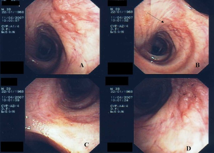 endobronchialis papillomatosis