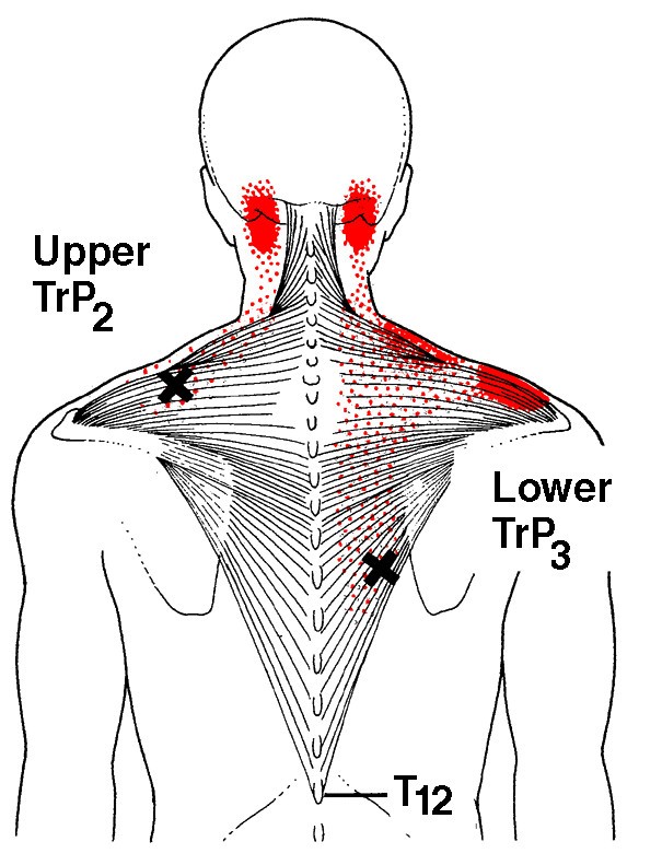 High prevalence of shoulder girdle muscles with myofascial trigger ...