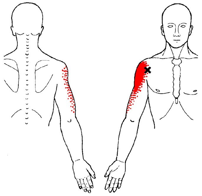 travell and simons referred pain travell and simons referred pain
