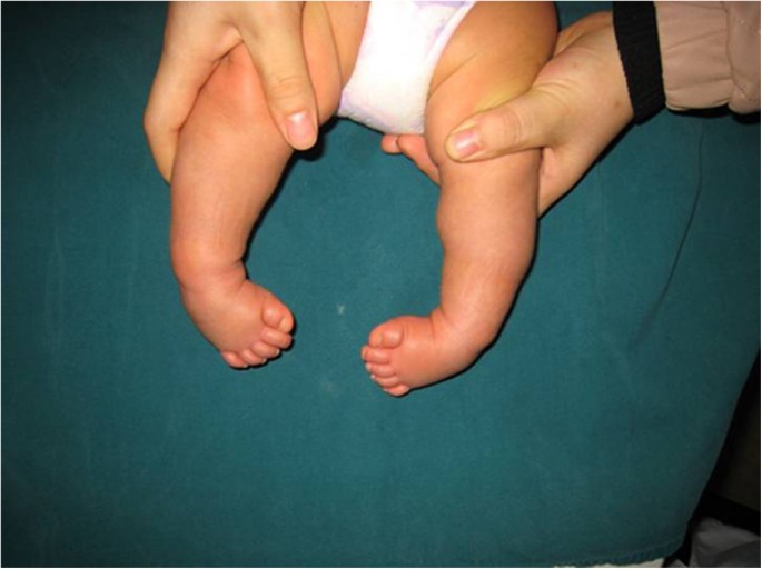 Manipulation And Brace Fixing For The Treatment Of Congenital Clubfoot In Newborns And Infants Bmc Musculoskeletal Disorders Full Text