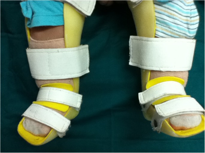 Manipulation and brace fixing for the treatment of congenital clubfoot in  newborns and infants | BMC Musculoskeletal Disorders | Full Text