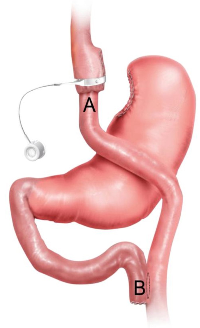Disciplinair bagageruimte bijtend Laparoscopic adjustable banded roux-en-y gastric bypass as a primary  procedure for the super-super-obese (body mass index > 60 kg/m2) | BMC  Surgery | Full Text