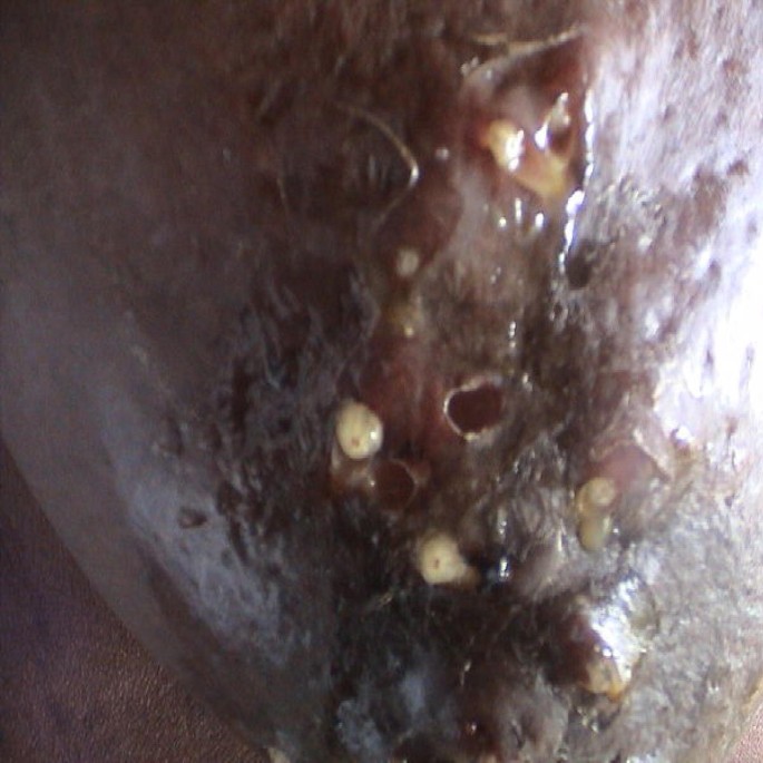 Furuncular Myiasis Of The Breast Caused By The Larvae Of The Tumbu Fly Cordylobia Anthropophaga Bmc Surgery Full Text tumbu fly cordylobia anthropophaga