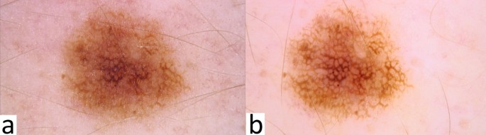 benign nevus