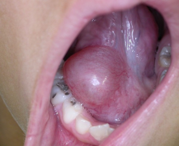 mucocele floor of mouth