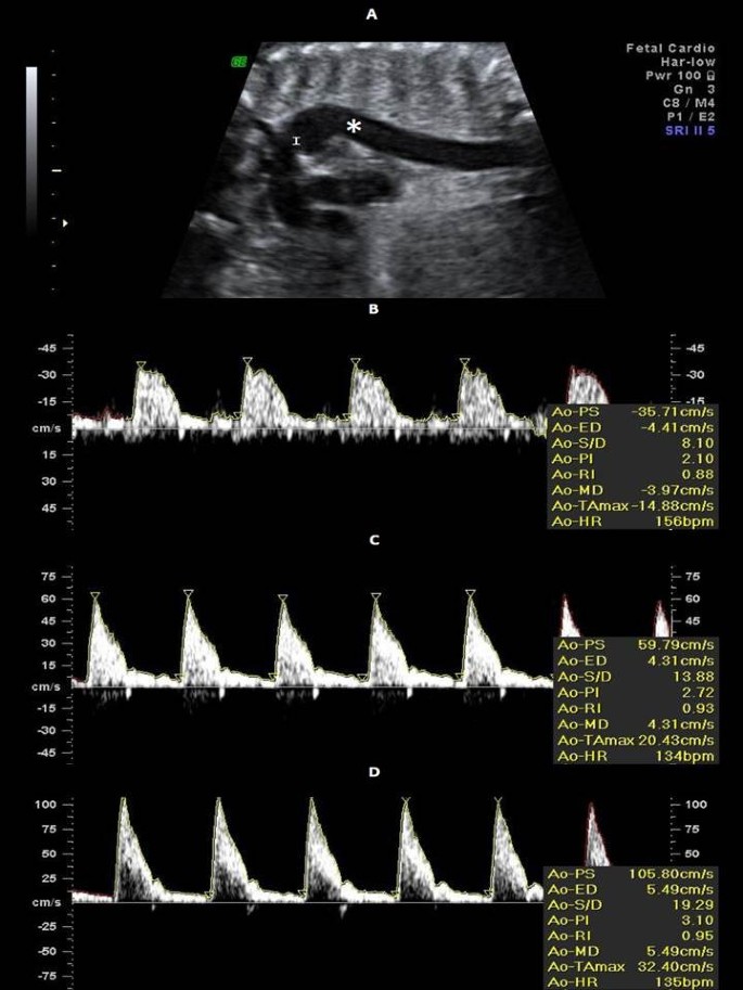 Foetal Aortic Flow Velocity Waveforms In Healthy And Hypertensive Pregnant Women Cardiovascular Ultrasound Full Text