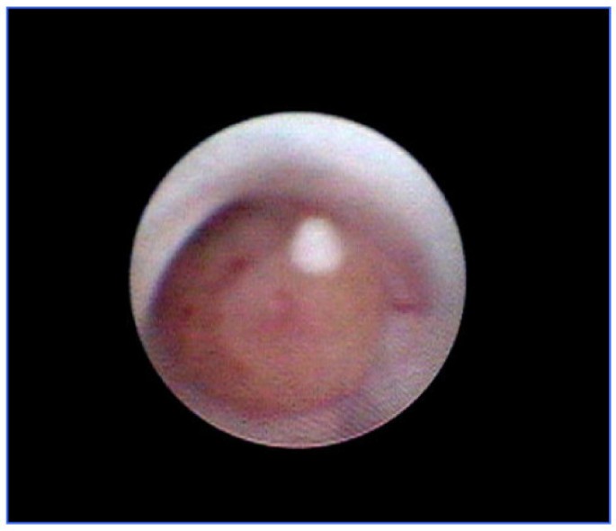 can intraductal papilloma go away