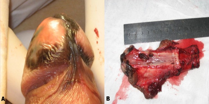 Malignant melanoma of the penis and urethra: one case report | World  Journal of Surgical Oncology | Full Text