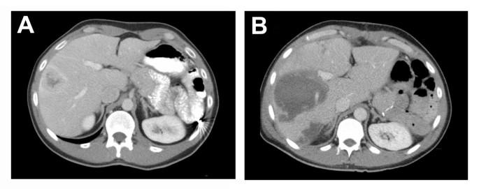 Neuroendocrine cancer with liver mets