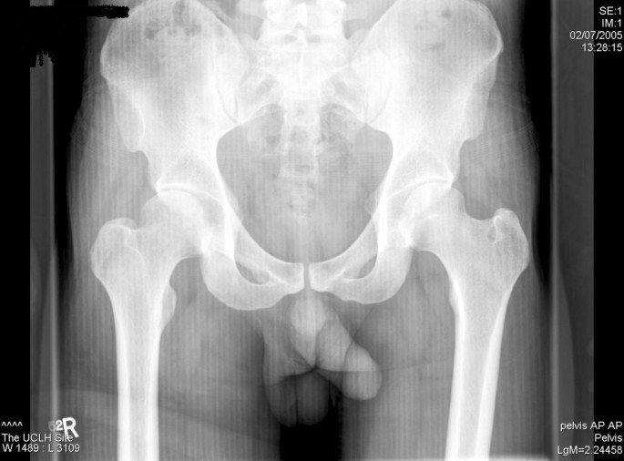 rectal cancer hip pain)