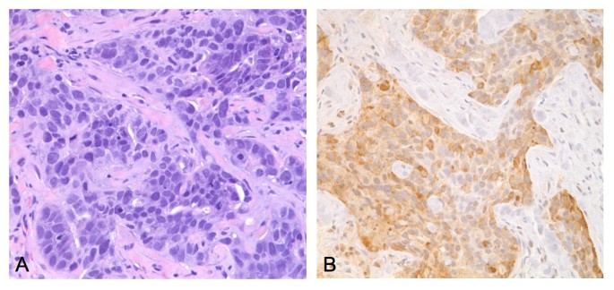 Prognostic implications of immunohistochemically detected YKL-40 expression  in breast cancer | World Journal of Surgical Oncology | Full Text