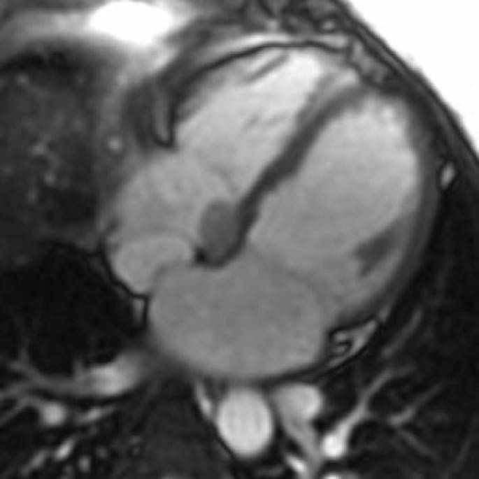 atrioventricular node