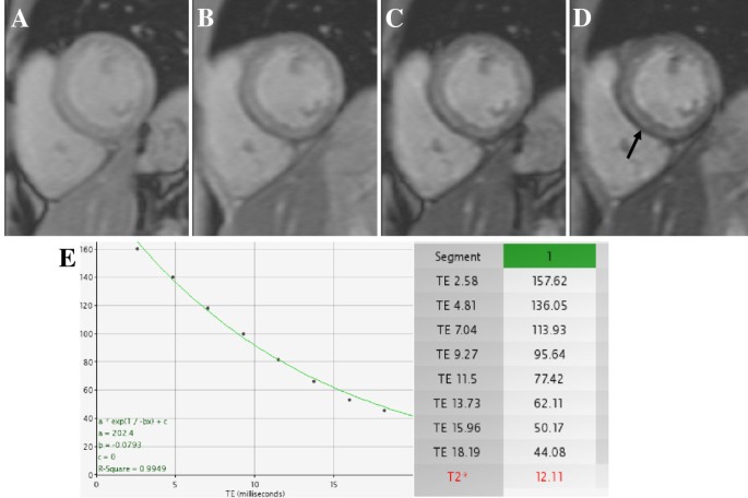 Diagnostic And Prognostic Value Of Cardiovascular Magnetic Resonance In Non Ischaemic Cardiomyopathies Journal Of Cardiovascular Magnetic Resonance Full Text Diagnostic And Prognostic Value Of Cardiovascular Magnetic Resonance In Non Ischaemic Cardiomyopathies Journal Of Cardiovascular Magnetic Resonance Full Text