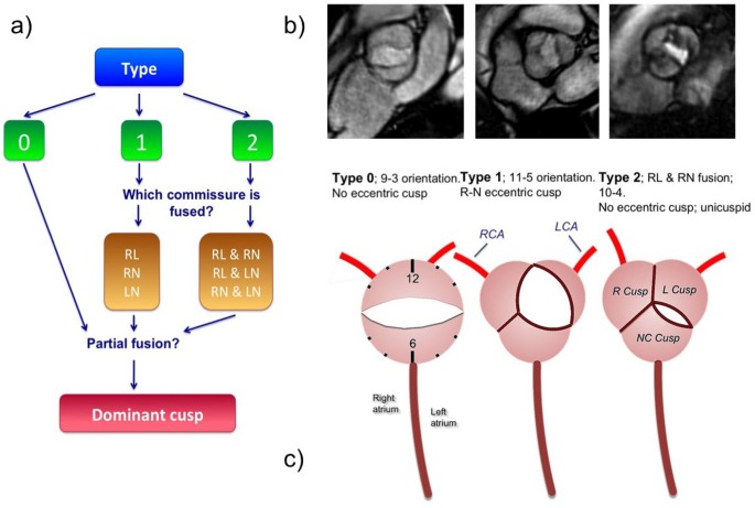 bicuspid aortic valve types