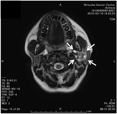 adenoid cystic carcinoma mri)