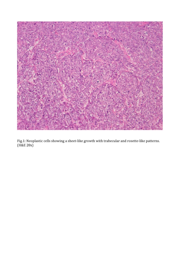 Neuroendocrine cancer in bladder