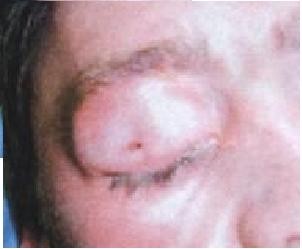 Penetrating eyelid injury: a case report and review of literature, Head &  Face Medicine