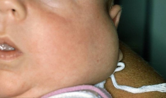 submandibular gland swelling in children