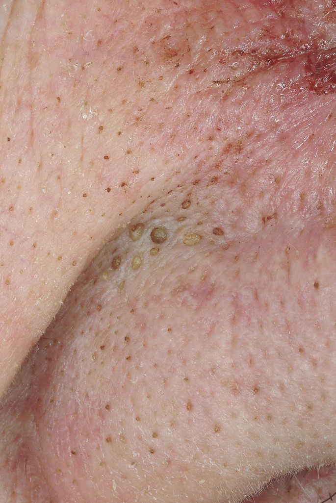 melanoma inside nose