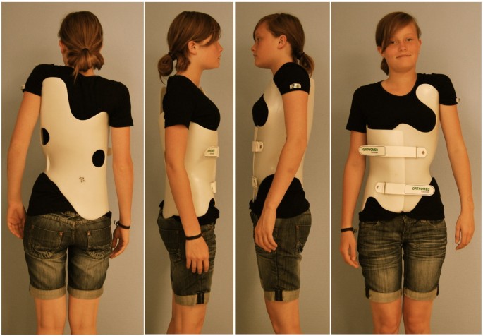 Brace technology" thematic series - the Gensingen brace™ in the treatment  of scoliosis | Scoliosis and Spinal Disorders | Full Text